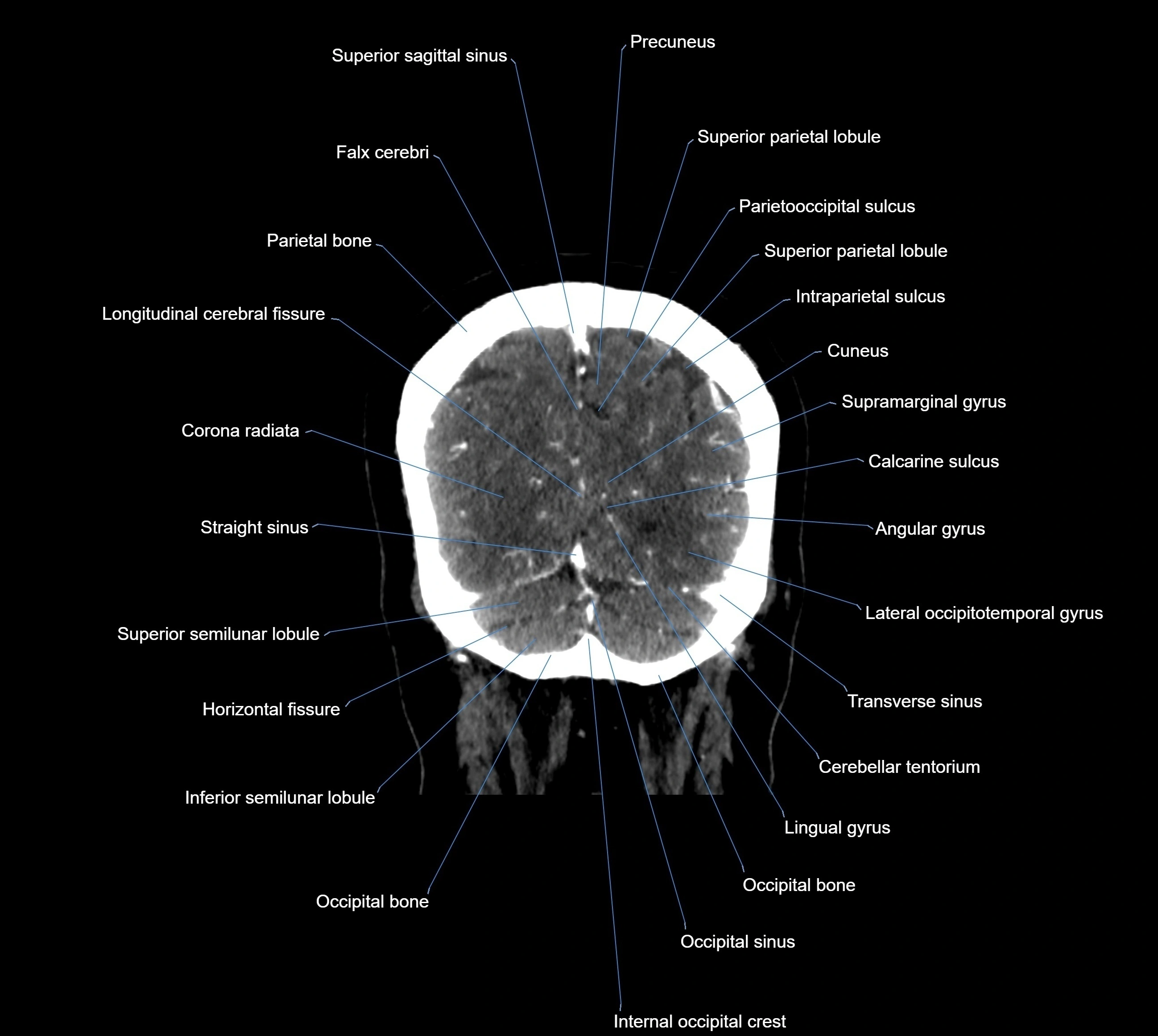 CT Brain coronal cross sectional radiology anatomy image  -img-00001-039.webp